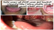 الدفتيريا تدق جرس الإنذار في سوس ماسة بؤرتان عائليتان وحالتا وفاة والتحريات تستنفر القطاع الصحي