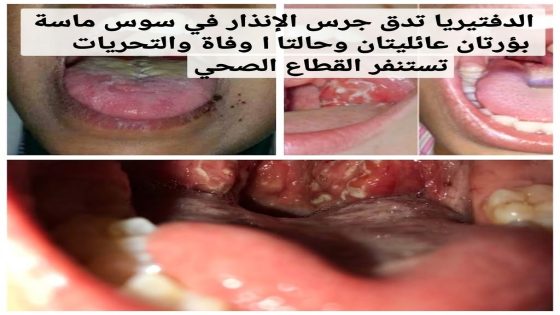 الدفتيريا تدق جرس الإنذار في سوس ماسة بؤرتان عائليتان وحالتا وفاة والتحريات تستنفر القطاع الصحي